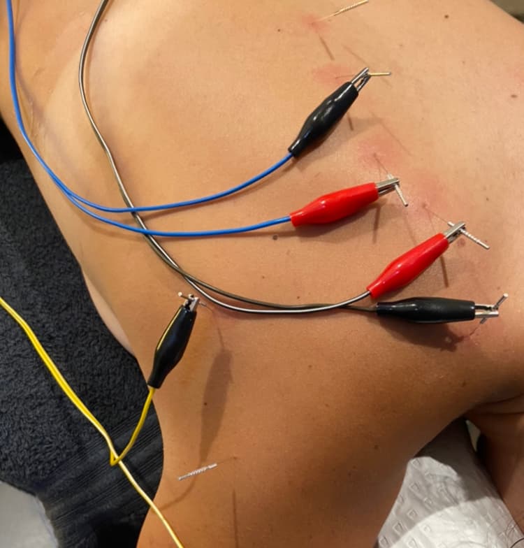 Brunswick Myotherapy & Recovery Clinic — Brunswick, Melbourne